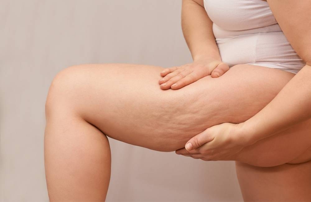 9 Best Cosmetic Treatments for Cellulite