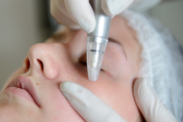 What is Microdermabrasion and Why Your Skin Needs It